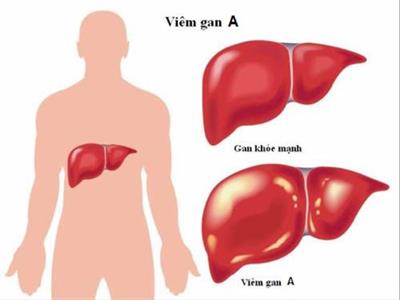 Learn about hepatitis A and how to prevent it